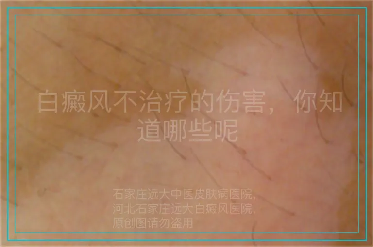 白癜风不治疗的伤害,你知道哪些呢