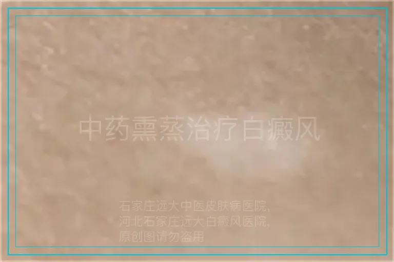 中药熏蒸治疗白癜风