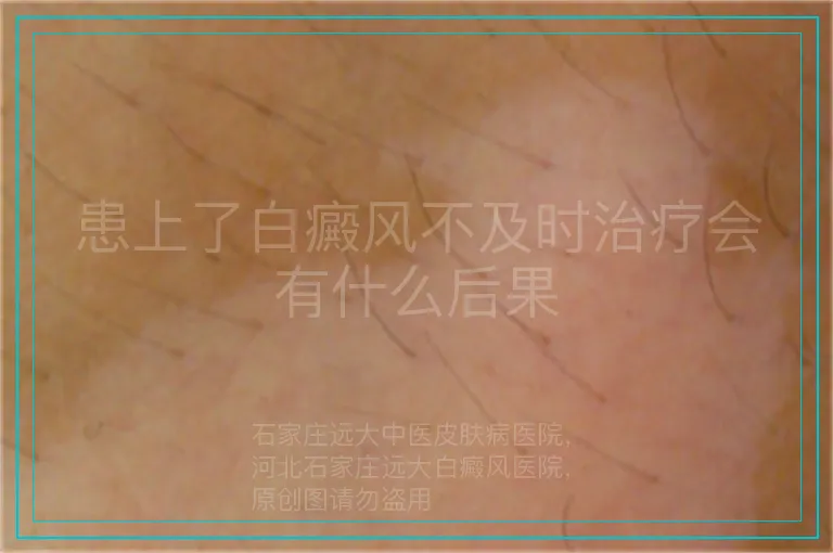 患上了白癜风不及时治疗会有什么后果