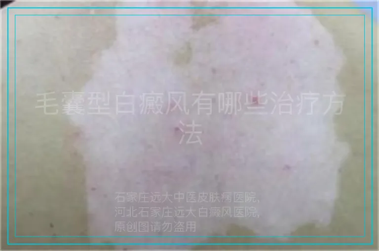 毛囊型白癜风有哪些治疗方法