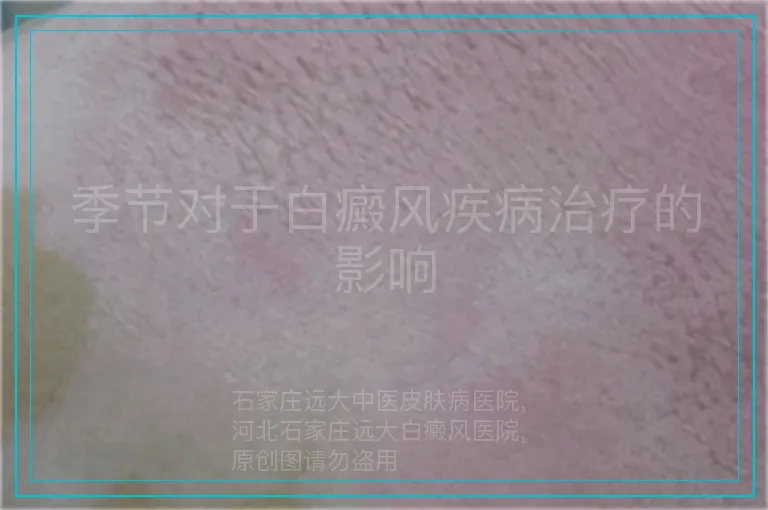 季节对于白癜风疾病治疗的影响