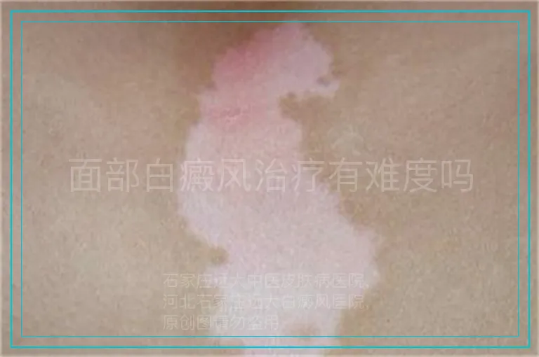 面部白癜风治疗有难度吗