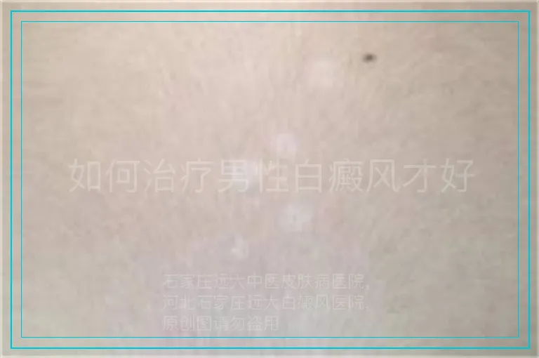 如何治疗男性白癜风才好