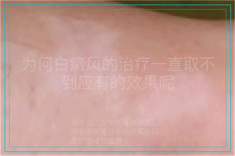 为何白癜风的治疗一直取不到应有的效果呢