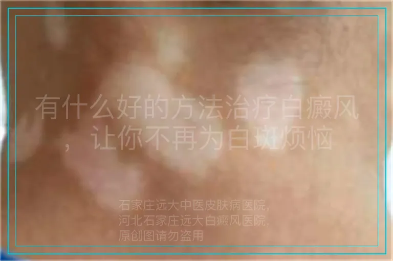 有什么好的方法治疗白癜风,让你不再为白斑烦恼