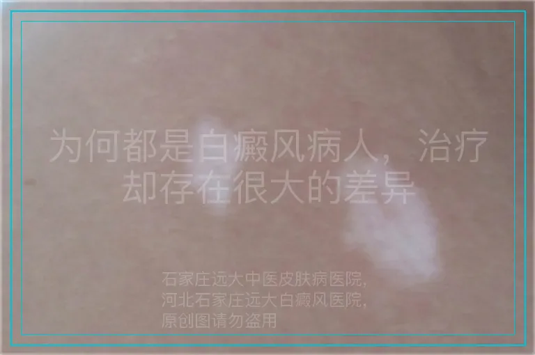 为何都是白癜风病人,治疗却存在很大的差异