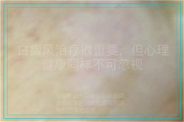 白癜风治疗很重要,但心理健康同样不可忽视