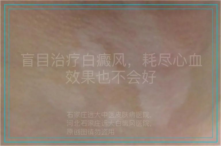 盲目治疗白癜风,耗尽心血效果也不会好