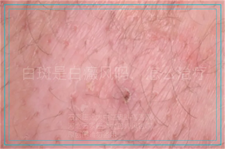 白斑是白癜风吗，怎么治疗