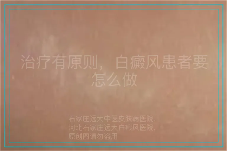 治疗有原则,白癜风患者要怎么做