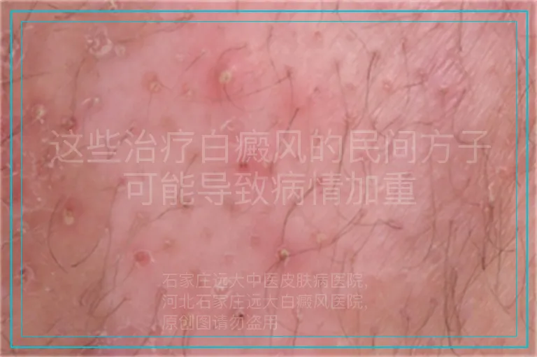 这些治疗白癜风的民间方子可能导致病情加重