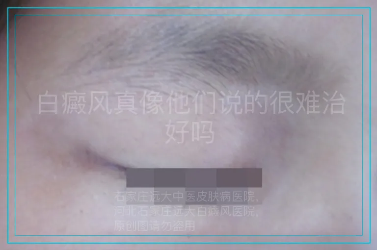 白癜风真像他们说的很难治好吗