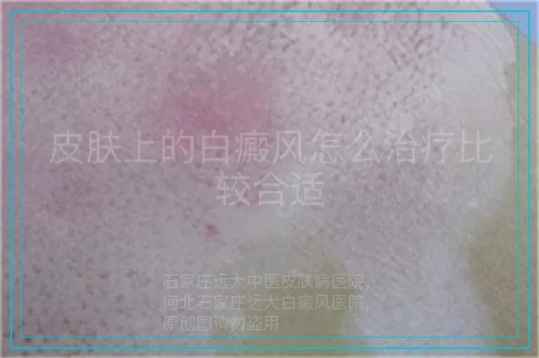 皮肤上的白癜风怎么治疗比较合适