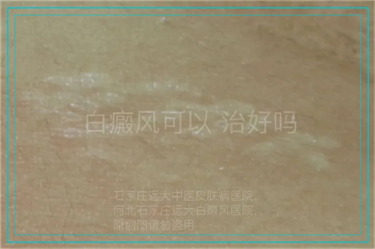 白癜风可以 治好吗