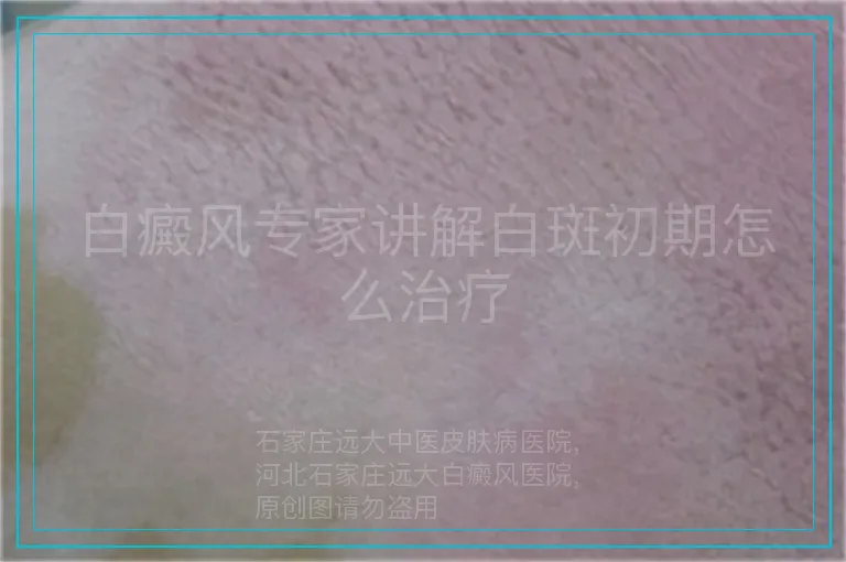 白癜风专家讲解白斑初期怎么治疗