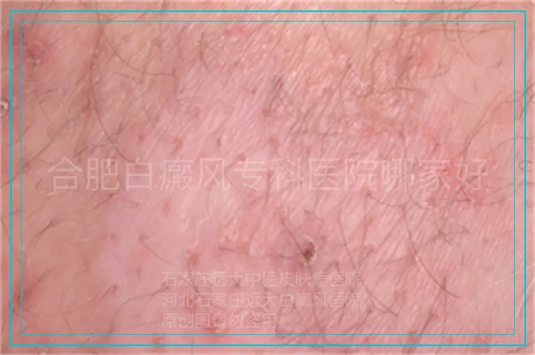 合肥白癜风专科医院哪家好