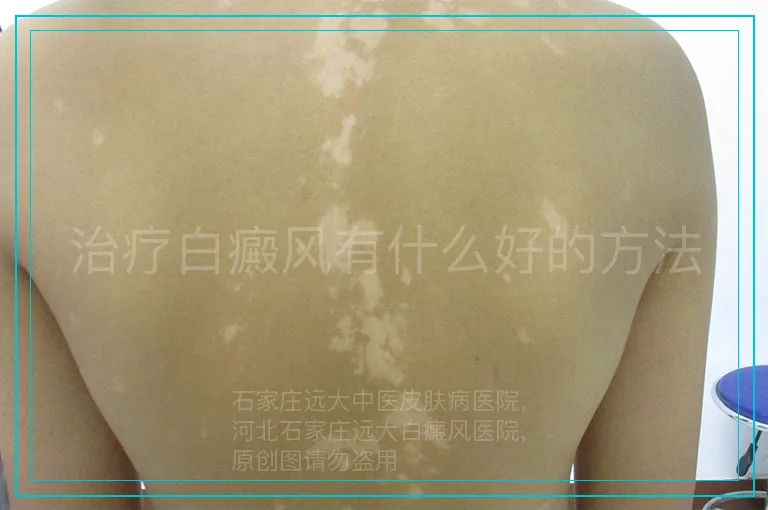 治疗白癜风有什么好的方法