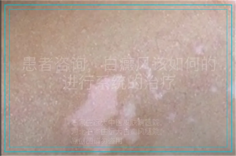患者咨询，白癜风该如何的进行系统的治疗