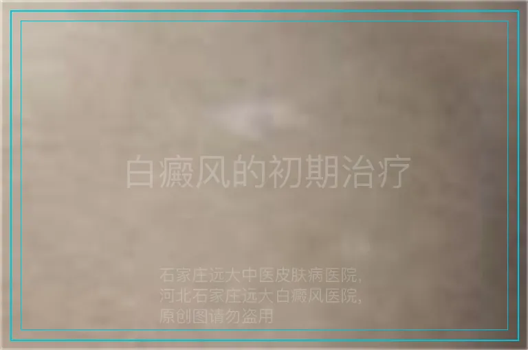 白癜风的初期治疗