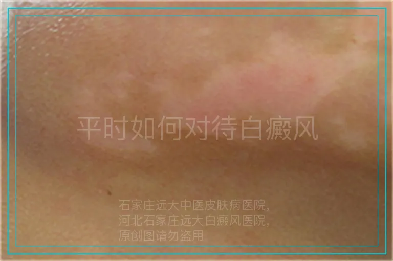 平时如何对待白癜风
