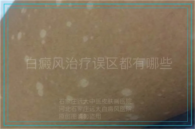 白癜风治疗误区都有哪些