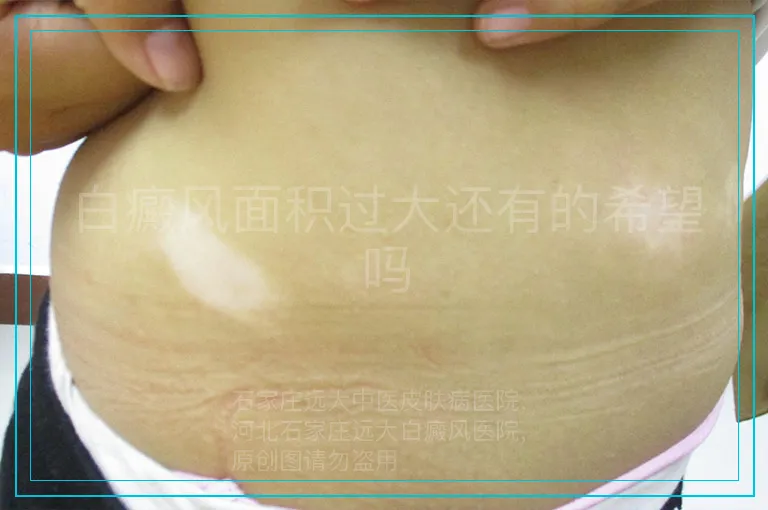 白癜风面积过大还有的希望吗