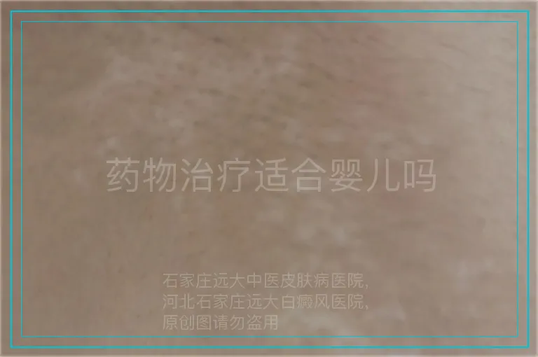 药物治疗适合婴儿吗