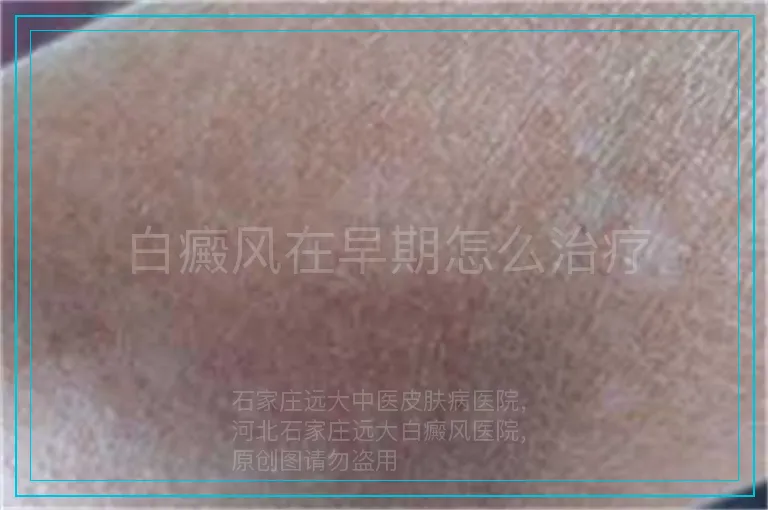 白癜风在早期怎么治疗