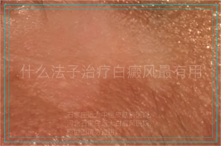 什么法子治疗白癜风最有用