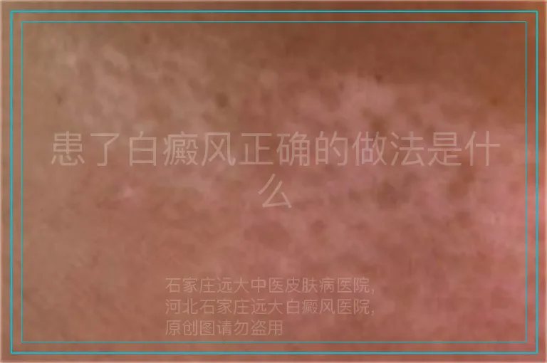 患了白癜风正确的做法是什么