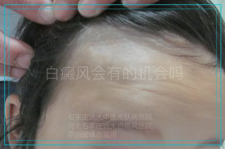 白癜风会有的机会吗