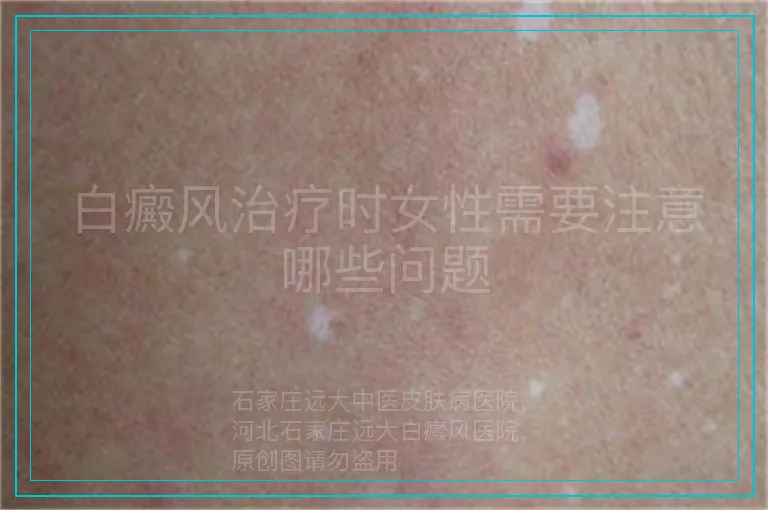 白癜风治疗时女性需要注意哪些问题