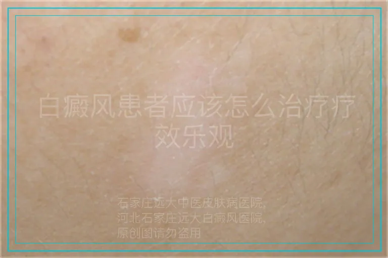白癜风患者应该怎么治疗疗效乐观