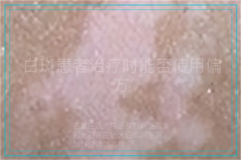 白斑患者治疗时能否使用偏方