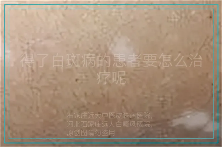得了白斑病的患者要怎么治疗呢