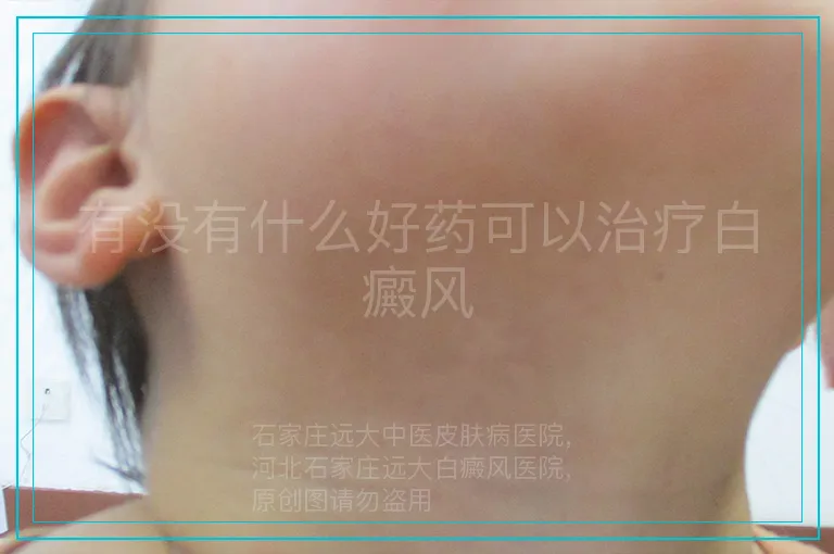 有没有什么好药可以治疗白癜风