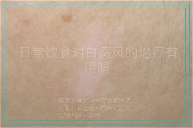 日常饮食对白癜风的治疗有用吗