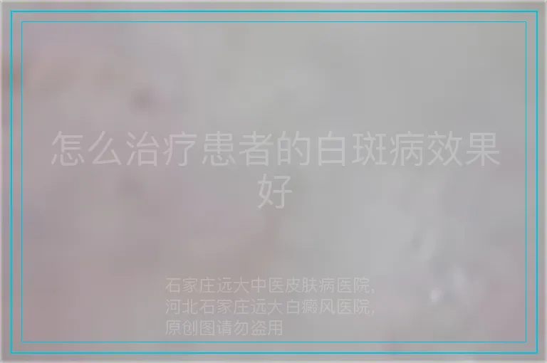怎么治疗患者的白斑病效果好