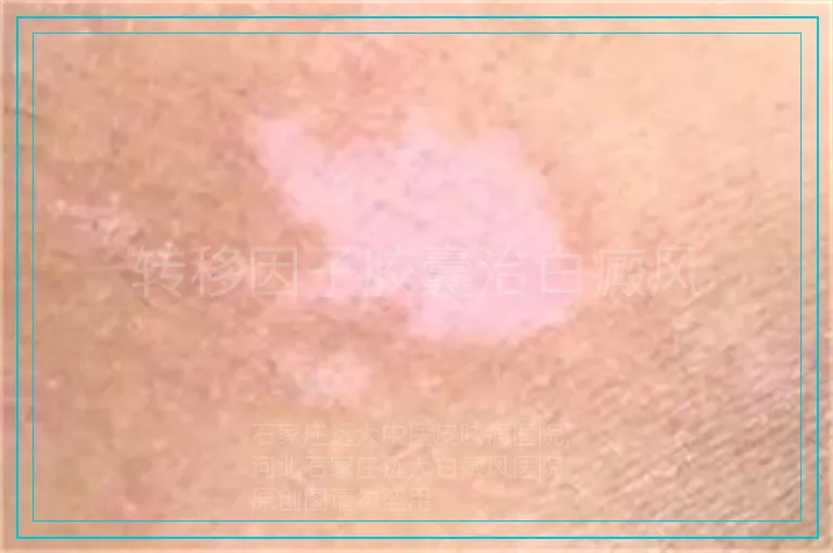 转移因子胶囊治白癜风