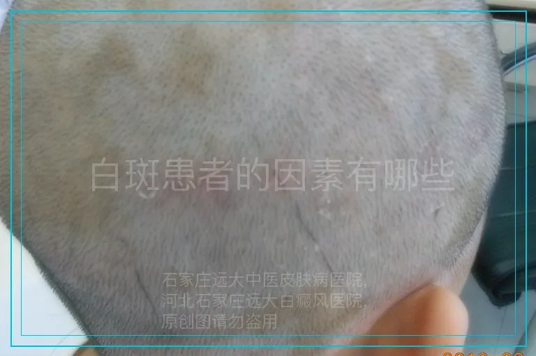 白斑患者的因素有哪些