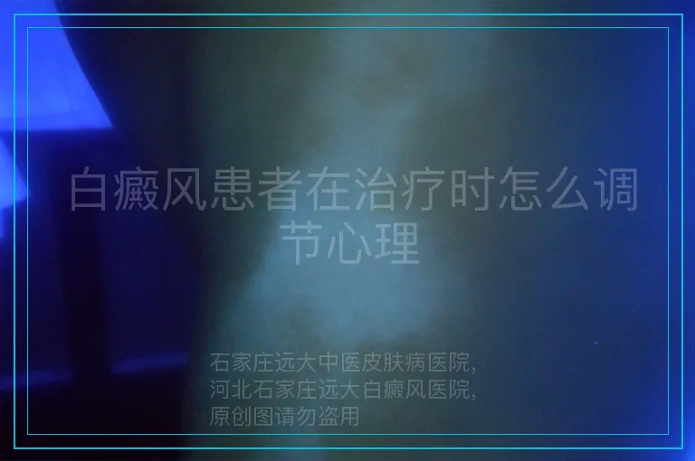 白癜风患者在治疗时怎么调节心理
