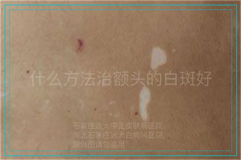 什么方法治额头的白斑好