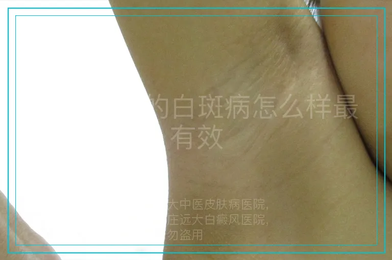 治疗患者的白斑病怎么样最有效