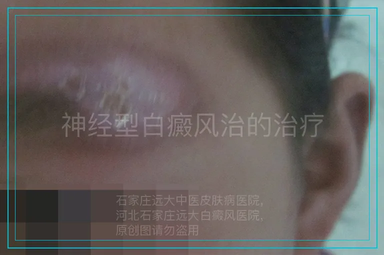 神经型白癜风治的治疗