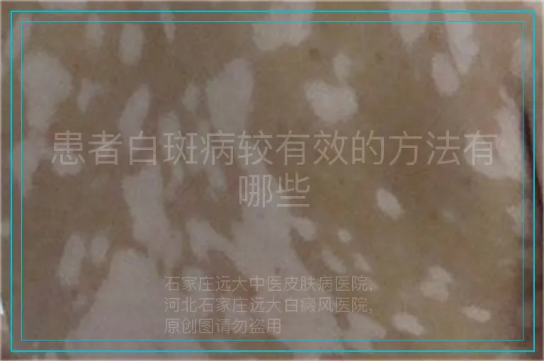 患者白斑病较有效的方法有哪些