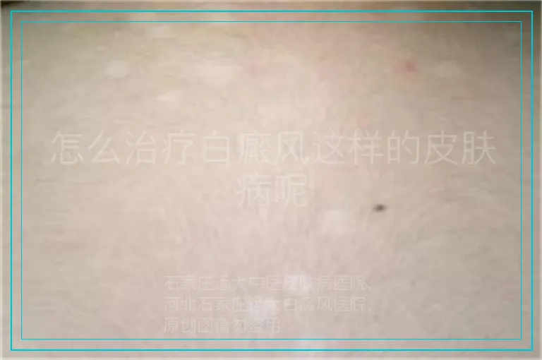 怎么治疗白癜风这样的皮肤病呢