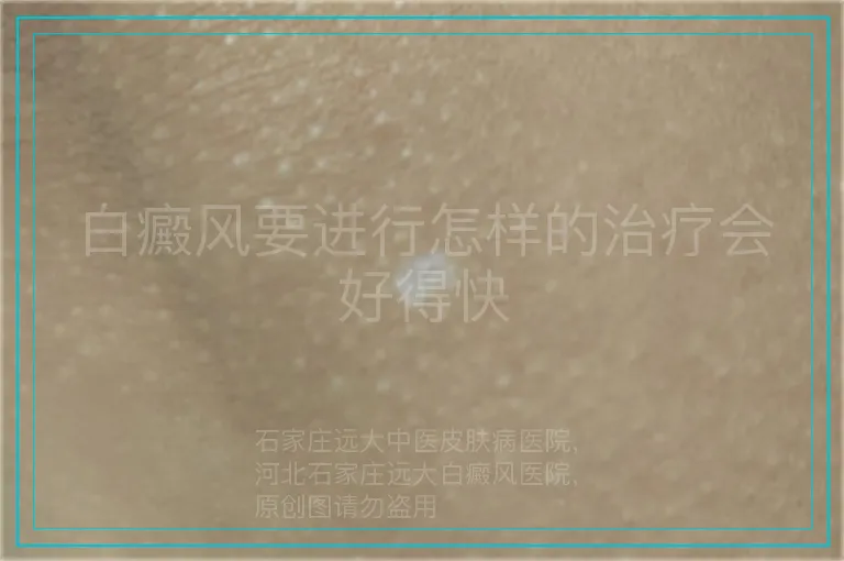白癜风要进行怎样的治疗会好得快