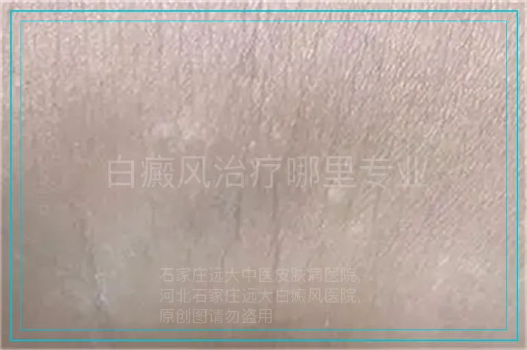 白癜风治疗哪里专业