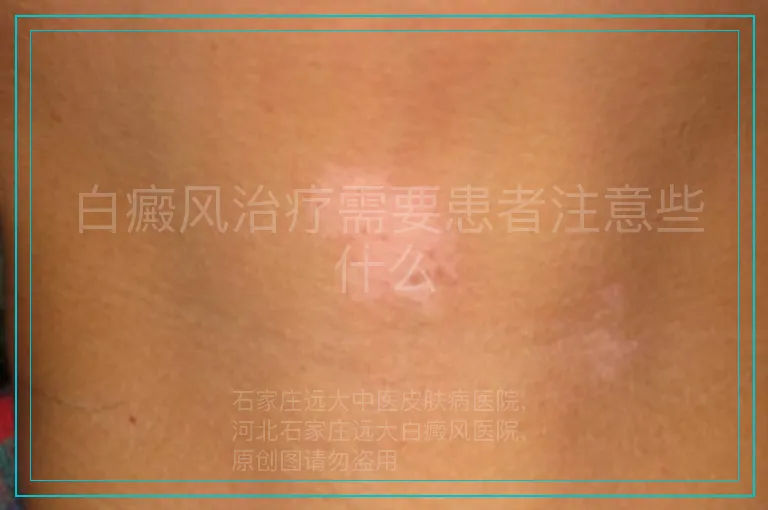 白癜风治疗需要患者注意些什么