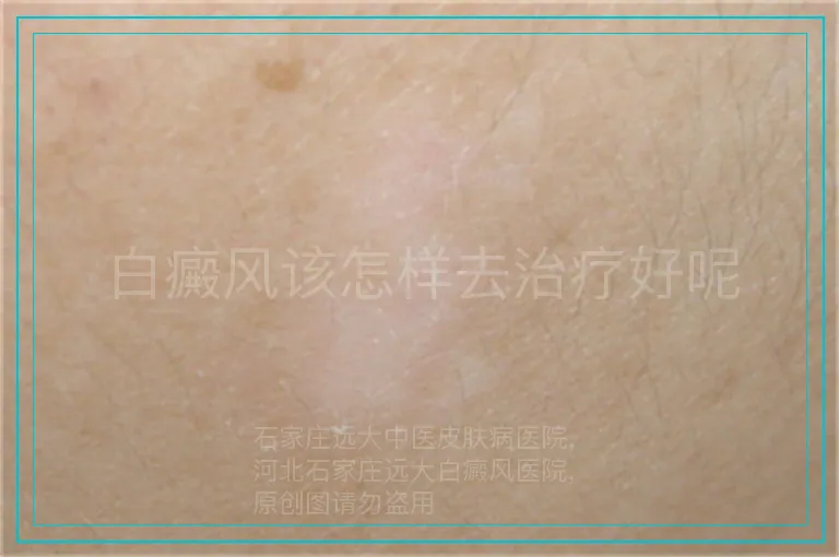 白癜风该怎样去治疗好呢